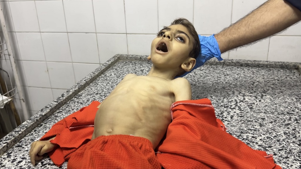 خلال 72 ساعة: 21 طفلا توفوا بسبب سوء التغذية والمجاعة في قطاع غزة